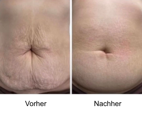 Refit - Gerät vorher/nachher Bild