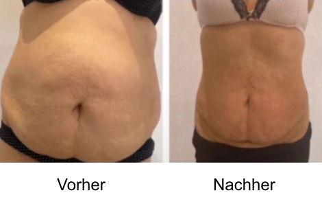 Refit - Gerät vorher/nachher Bild