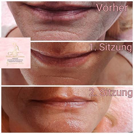 AquaPure2 Behandlung