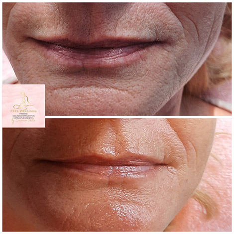 AquaPure2 Behandlung