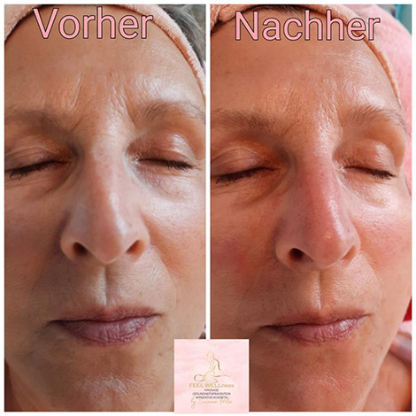 AquaPure2 Behandlung