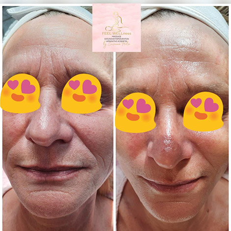 AquaPure2 Behandlung