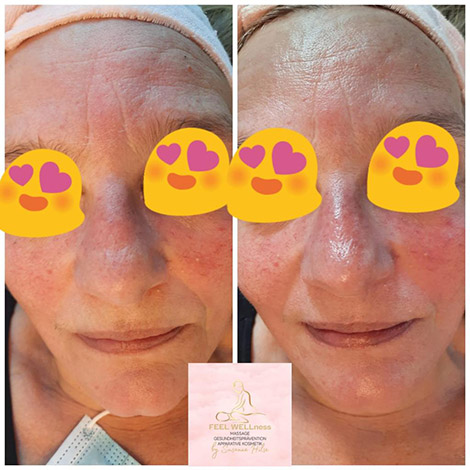 AquaPure2 Behandlung