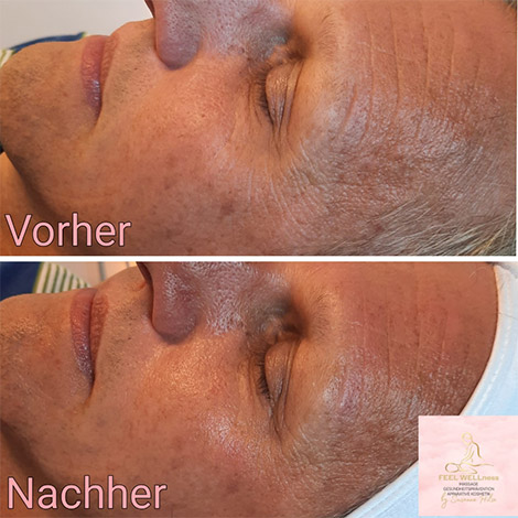 AquaPure2 Behandlung