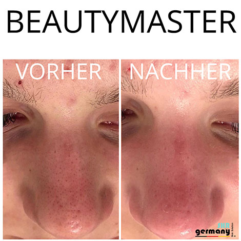 Beautymaster Behandlung