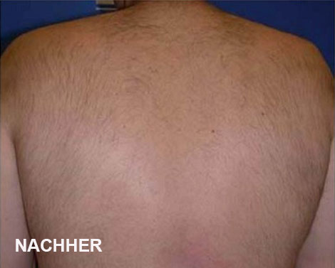 Diodenlaser Behandlung