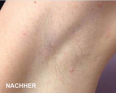 Diodenlaser Behandlung