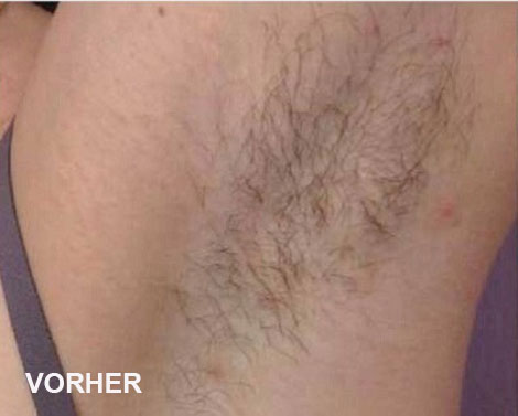 Diodenlaser Behandlung