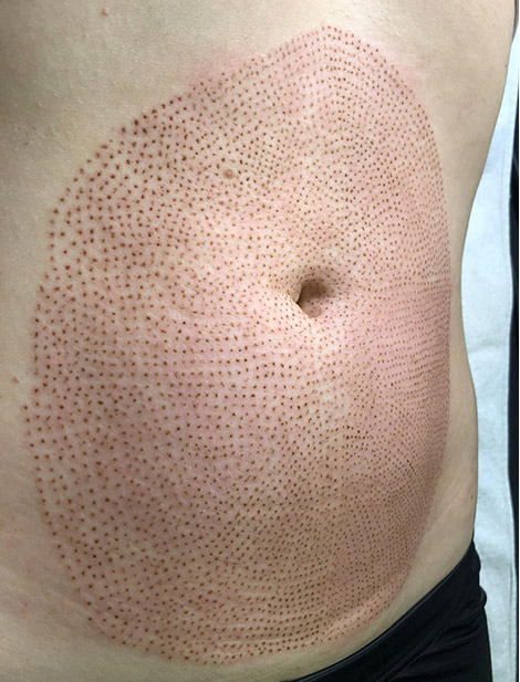 PlasmaPro Behandlung