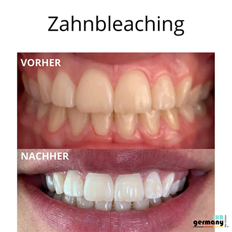 Zahnbleaching Behandlung