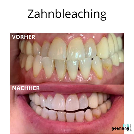 Zahnbleaching Behandlung