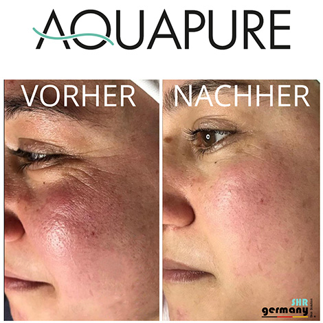 AquaPure Behandlung