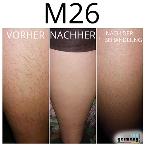 SHR M26 Behandlung