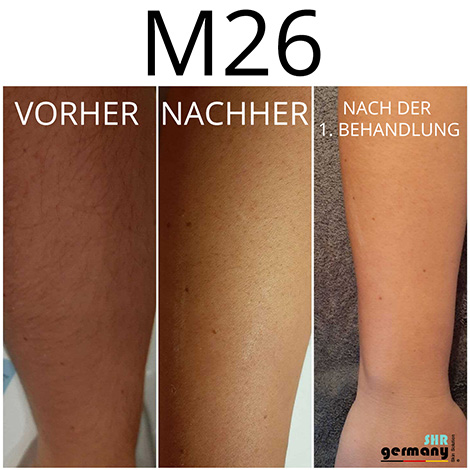 SHR M26 Behandlung