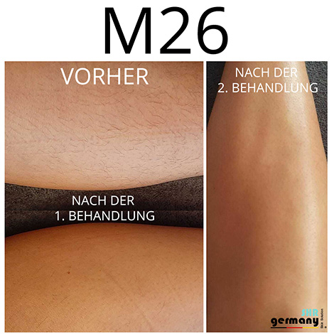 SHR M26 Behandlung