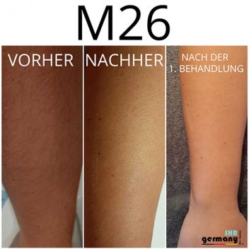 SHR M26 Behandlung